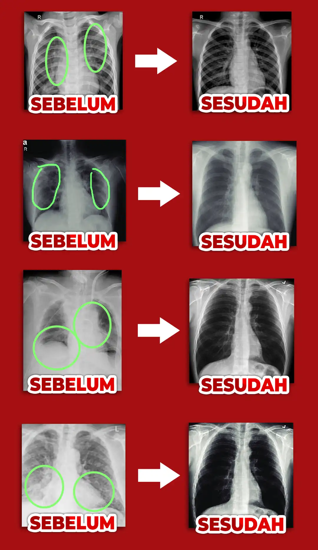 rontgen-sebelum-sesudah.png